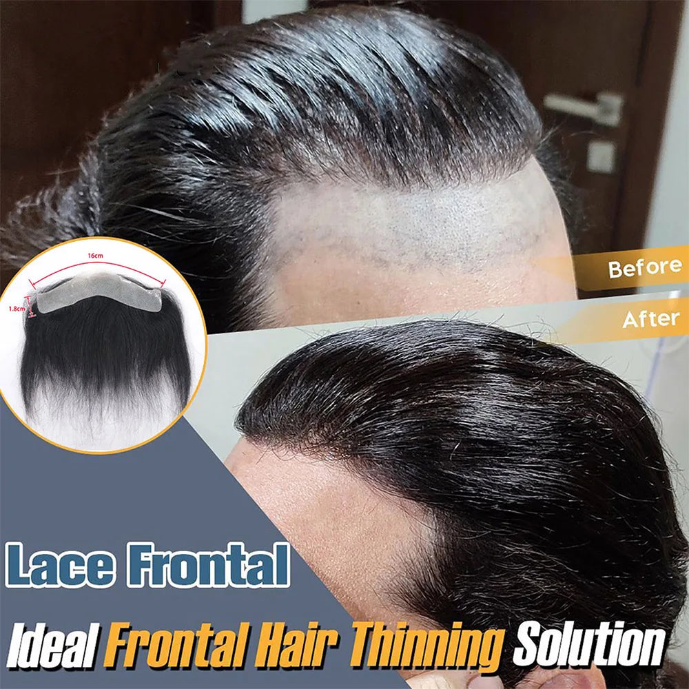 Tupé frontal hombre antes y después en las entradas | Dream Shop